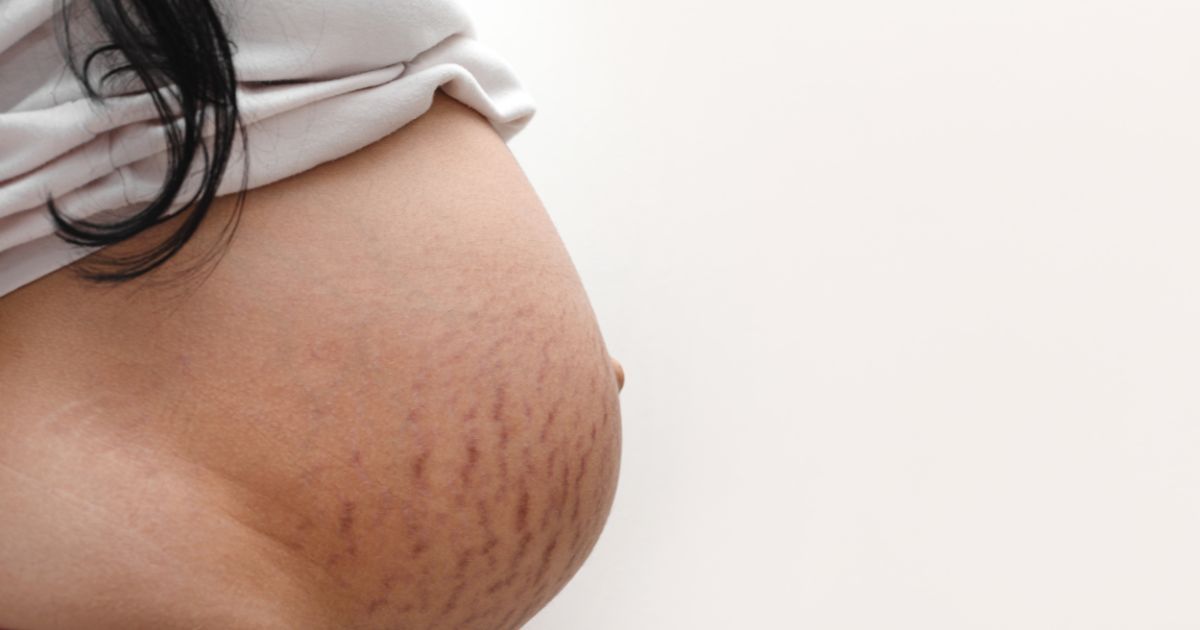 pregnant belly with stretch marks
