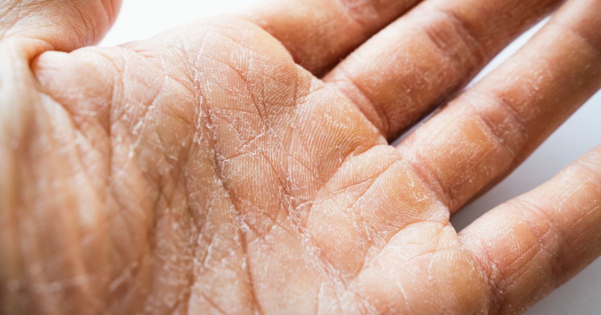 dry damaged skin on hand